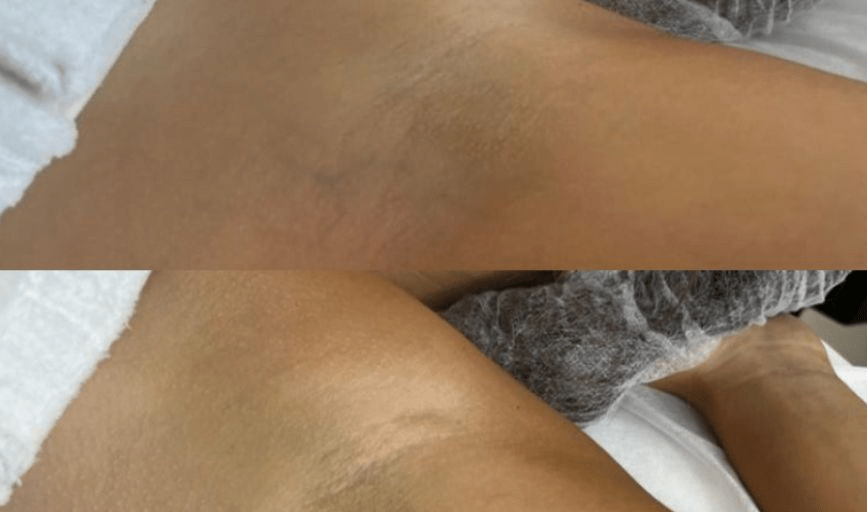 Body Bleaching.209